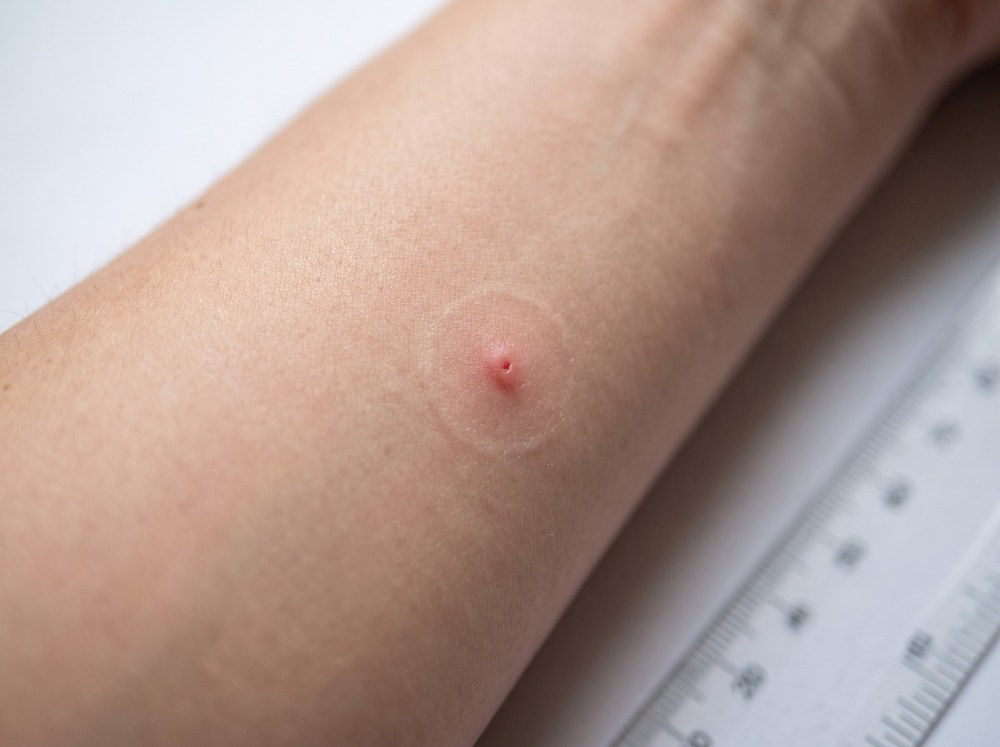 Close-up of small itchy red skin bumps sometimes mistaken for fruit fly bites but caused by another insect